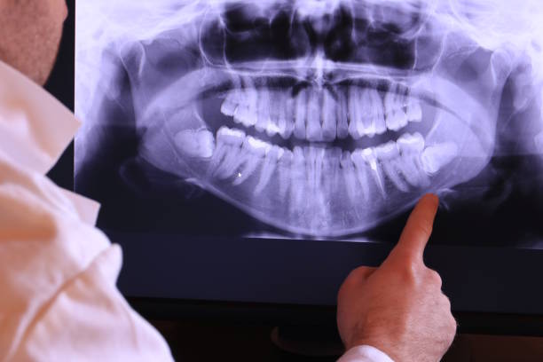 Best Emergency Wisdom Tooth Extraction in Keller, TX